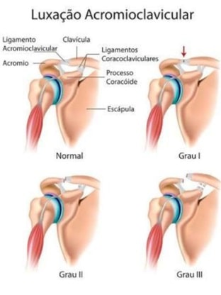 Luxação Acromio Clavicular: entenda a lesão de Réver e o prazo de retorno